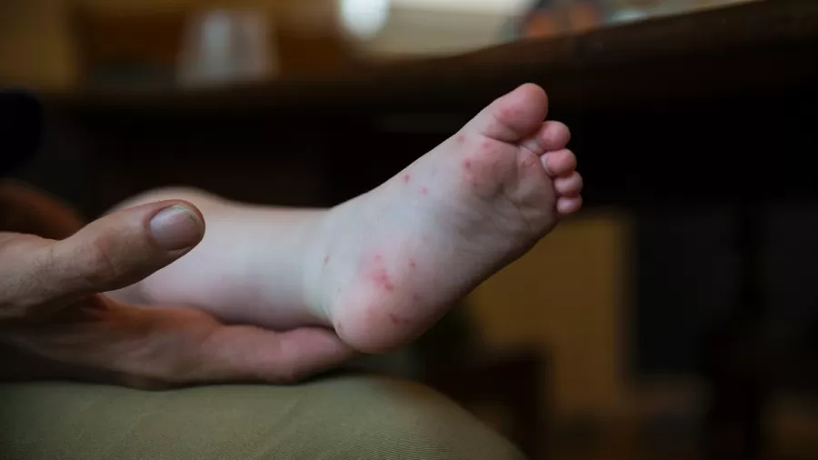 Doença mão-pé-boca é contagiosa e exige atenção aos sintomas e à hidratação