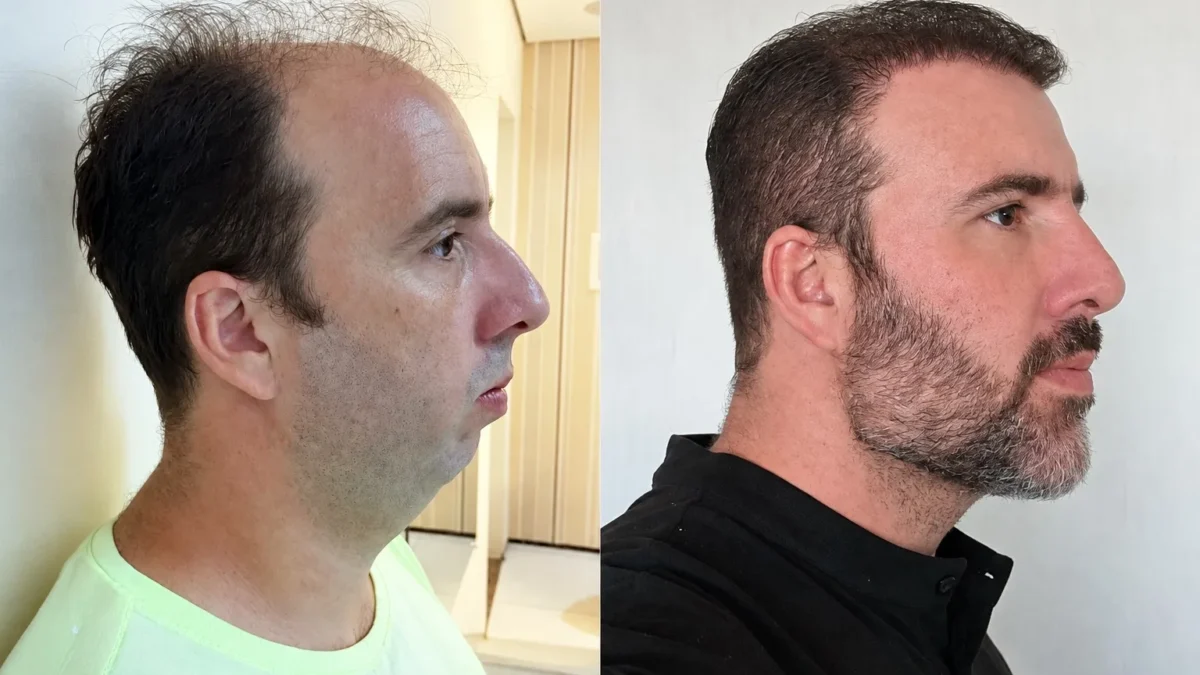 Harry fala em reconciliação e caso de harmonização viral agita redes