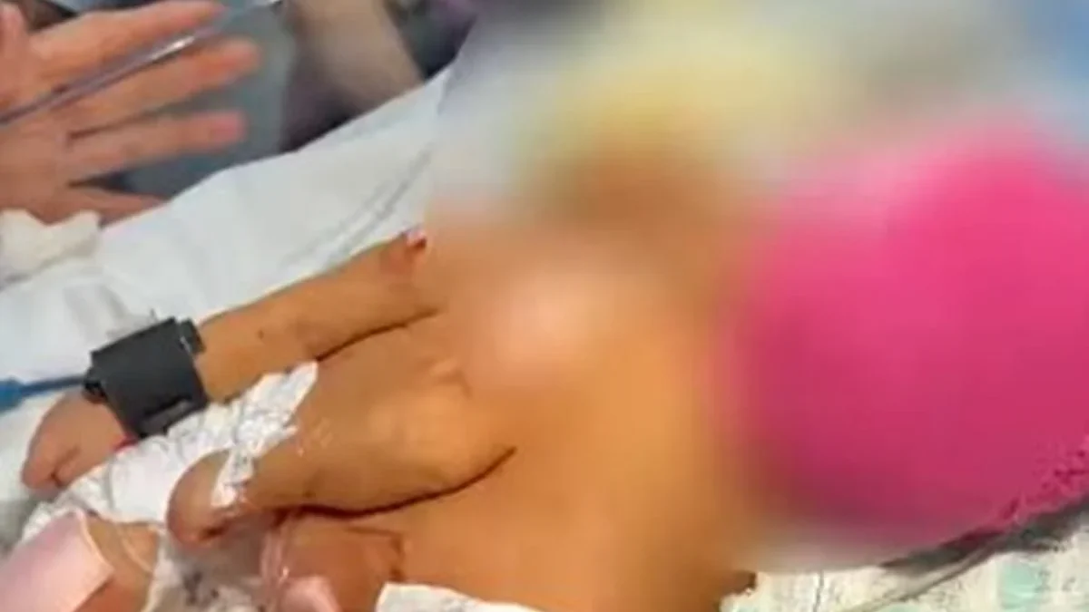 Gêmeas siamesas nascem no DF e passam por avaliação para possível cirurgia de separação