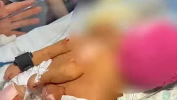 Gêmeas siamesas nascem no DF e passam por avaliação para possível cirurgia de separação