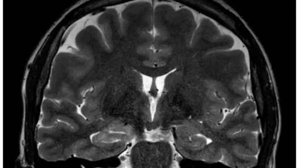 Mulher tem convulsões durante menstruação e médicos suspeitam de endometriose cerebral