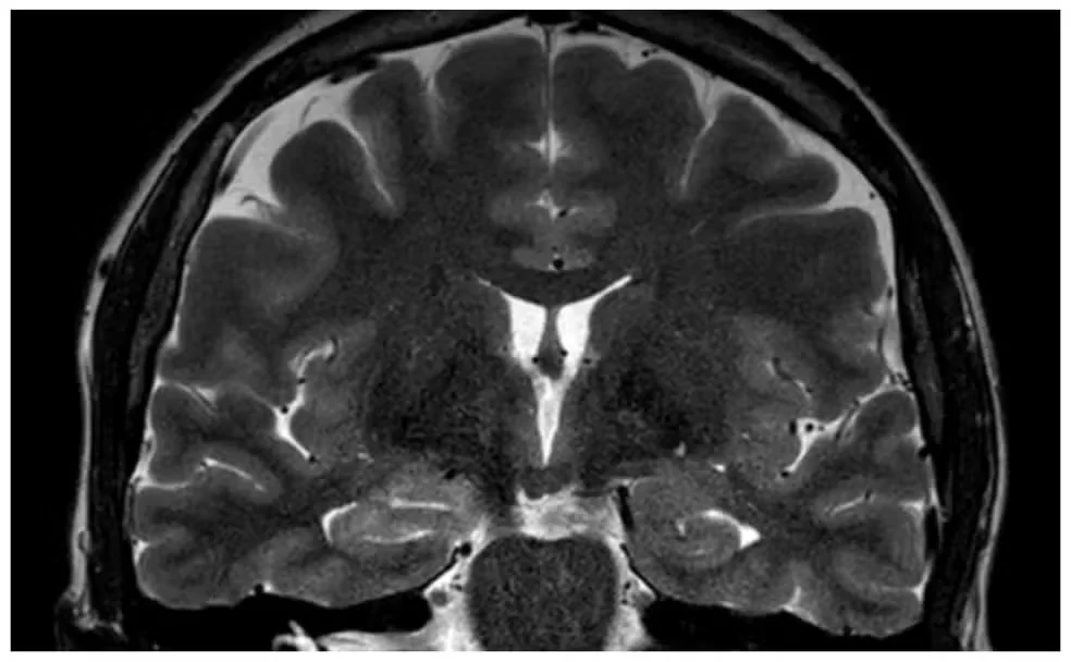 Mulher tem convulsões durante menstruação e médicos suspeitam de endometriose cerebral
