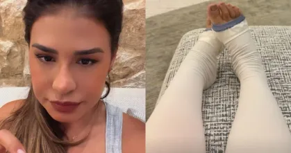 Simone Mendes revela retirada de 4 kg de pele em cirurgia ligada ao lipedema